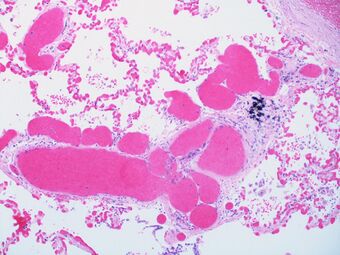 Pulmonary capillary hemangiomatosis (4348914308).jpg