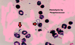 The process of hemolysis.png