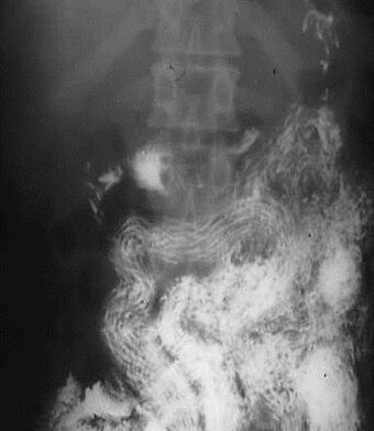 Ascaris infection in the x-ray image- ascaris arranged tidily along the long axis of the small bowel (South Africa) (16424840021).jpg