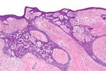 Basal cell carcinoma fibroepitheliomatous pattern - low mag.jpg