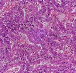 Colorectal adenocarcinoma, not otherwise specified.jpg