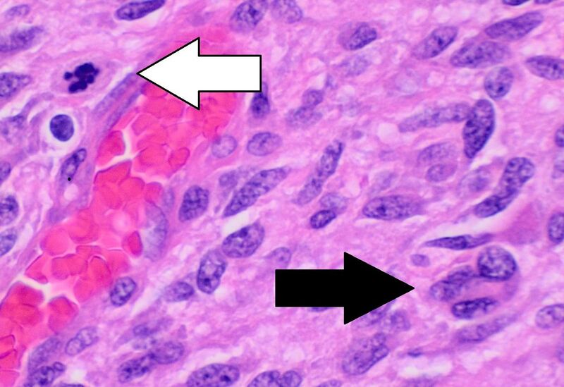 File:Histopathology of glioblastoma, high magnification, annotated.jpg