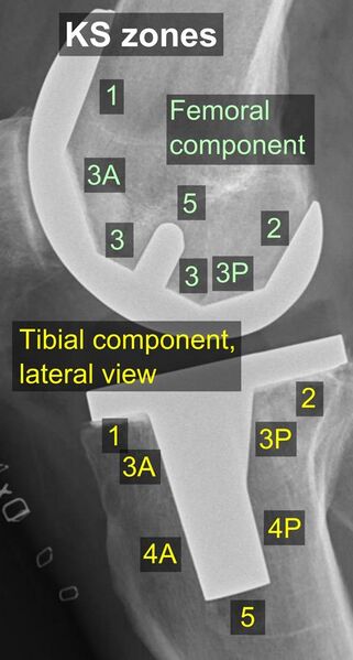 File:Knee prosthesis zones by Knee Society 2015, lateral view.jpg