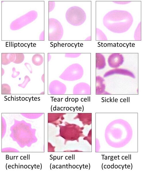 File:Poikilocytes - Red blood cell types.jpg