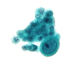 Serous carcinoma 2a - cytology.jpg