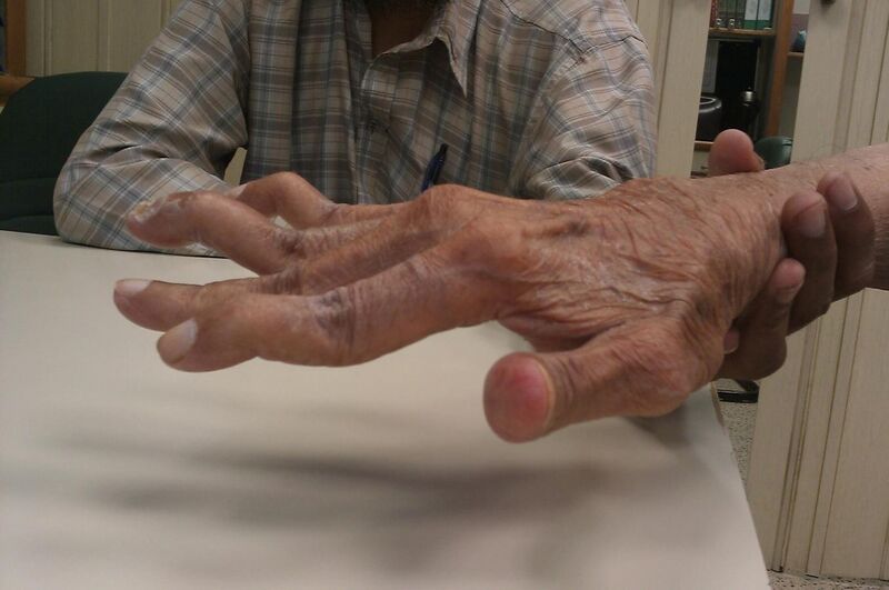 File:Swan neck deformity in a 65 year old Rheumatoid Arthritis patient- 2014-05-27 01-49.jpg