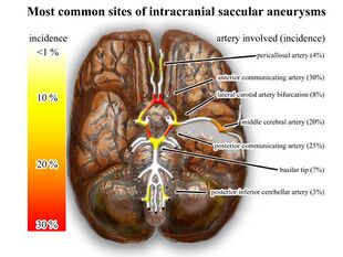 Wikipedia intracranial aneurysms - inferior view - heat map.jpg