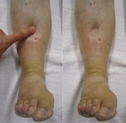 Image of a leg with "pitting" edema, a transient depression of the skin after pressure is applied. When this happens on one side, it increases the likelihood of DVT.