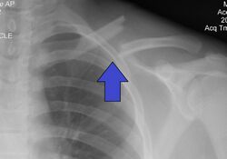 Clavicle Fracture Left.jpg