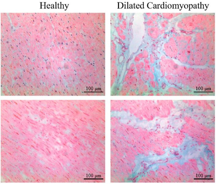 File:Histopathology of interstitial fibrosis in dilated cardiomyopathy.jpg