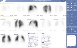 Lung scintigraphy keosys.JPG