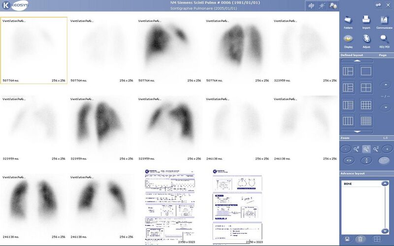 File:Lung scintigraphy keosys.JPG