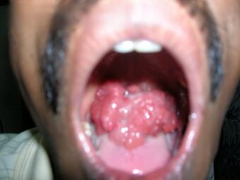 Rhinosporidiosis.jpg