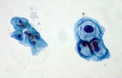 ThinPrep Pap smear HPV.jpeg