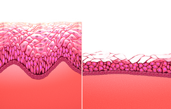 Side-by-side illustration depicting thinning effects of menopause on musoca of vaginal wall