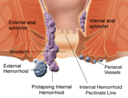 Internal and external hemorrhoids.png