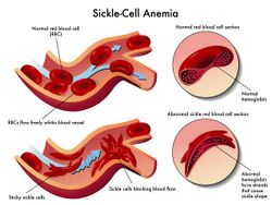 Risk-Factors-for-Sickle-Cell-Anemia (1)2.jpg