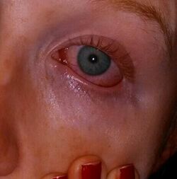 Actinic conjunctivitis causes a redness of the eyes, as well as swelling and often grayness around the eyes- 2014-05-21 23-27.JPG