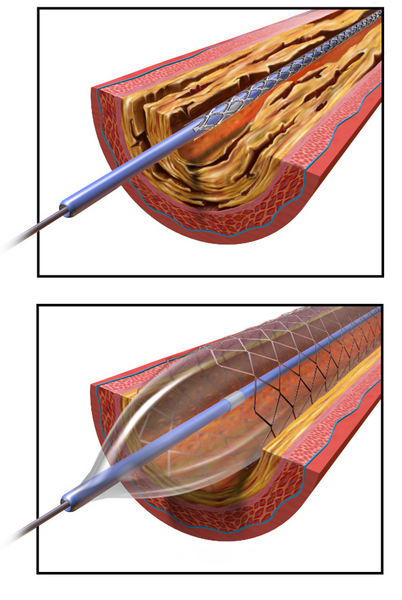 File:Angioplasty - Balloon Inflated with Stent.png