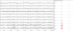 Human EEG with prominent alpha-rhythm