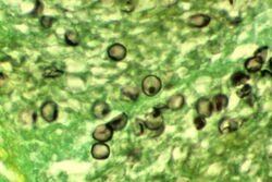 "P. jirovecii" cysts in tissue