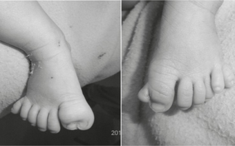 Polydactyly in a 1 day old infant due acrocallosal syndrome.png