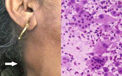 Rosai-Dorfman Disease in Elderly Female - Aziz Et Al Case Rep Pathol 2012.jpg