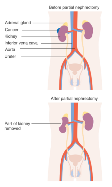 File:Diagram showing before and after a partial nephrectomy CRUK 102.svg