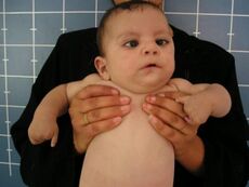 Infant with Möbius syndrome.jpg
