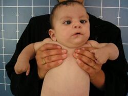 An infant with missing and malformed fingers. Partial facial paralysis due to bilateral sixth nerve palsies.