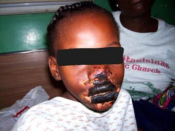 Girl with black gangrene and open sores on nose and lips