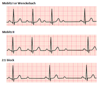 Second degree heart block.png