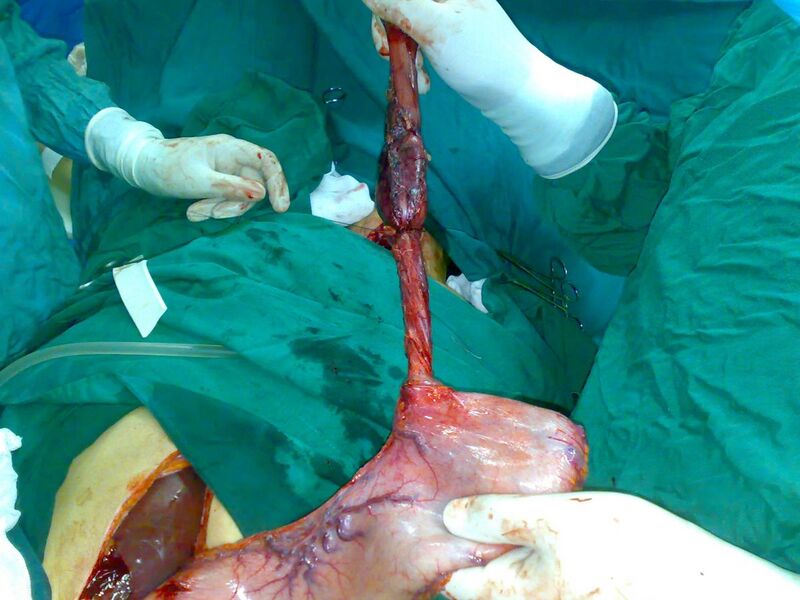 File:Surgical removal of the esophagus 06.jpg