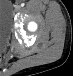 Tropical pyomyositis CT.JPG