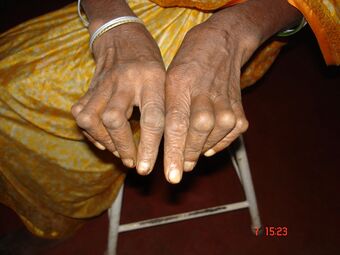 RA hand deformity.JPG