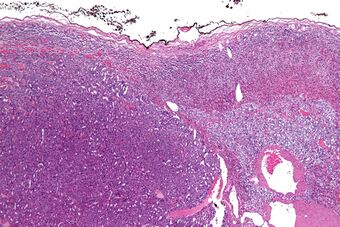 Adrenal cortical carcinoma - low mag.jpg