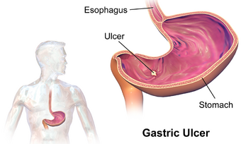 Gastric Ulcer.png