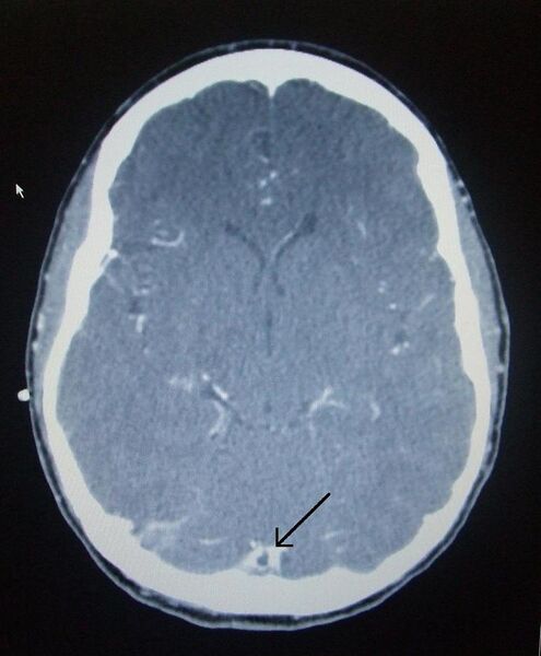 File:Sagital sinus thrombus.JPG