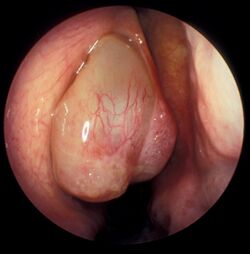 Nasal polyp in the middle meatus