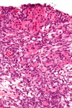 Sertoli-Leydig cell tumour - very high mag.jpg