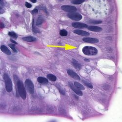 Cystoisospora belli oocyst in epithelial cell (hematoxylin and eosin).jpg
