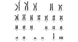 Peripheral-blood-karyotype-result-belonging-to-the-subject-compatible-with-48-XYYY.png