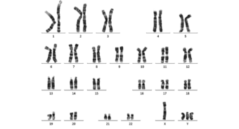 Peripheral-blood-karyotype-result-belonging-to-the-subject-compatible-with-48-XYYY.png