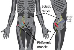 Piriformis syndrome.jpg