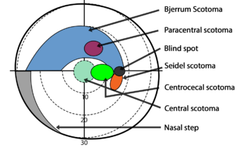 Types of scotomas and the location on the retina.png