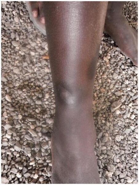 File:10.1177 0956462414549036-fig8-Primary yaws, healed Lesion.jpg