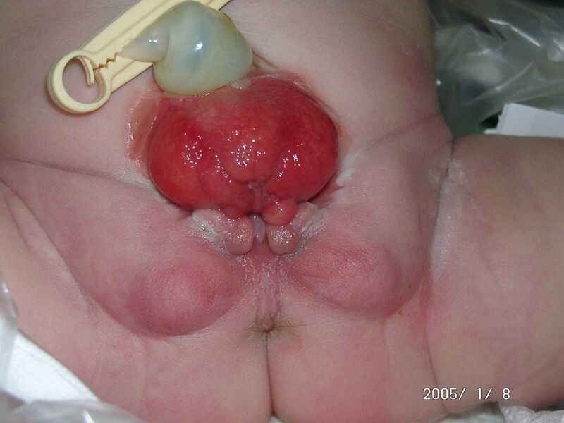 File:Classical bladder exstrophy.jpg