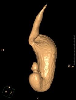 Normal-ct-virtual-gastroscopy.jpg