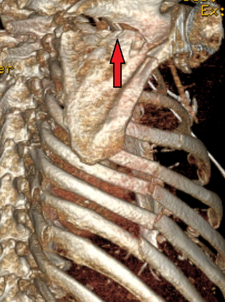 File:ScapulaFracture.png