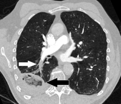 CT of lung infarction with reverse halo sign, annotated.png